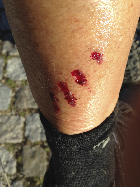 Chain gouge - ouch!